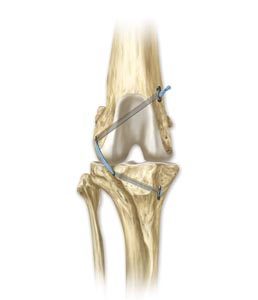 extra-capsular structure stabilization illustrated diagram